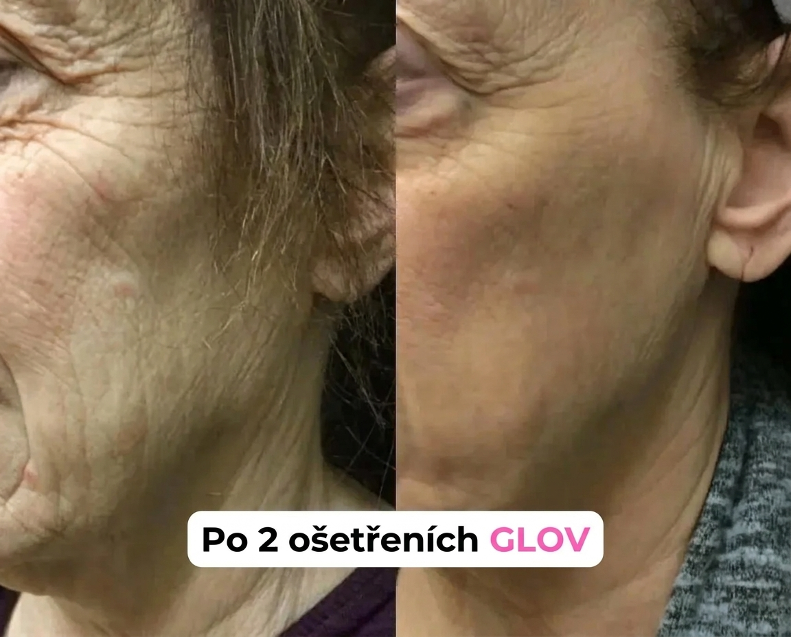 Celvea micro needle serum