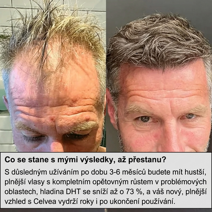 Hair Regrowth System Microneedle Essence